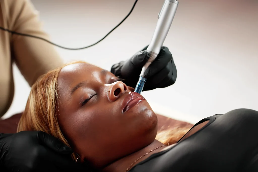 Microneedling dans nos centres DermaPro : L’Innovation au Service de Votre Peau
