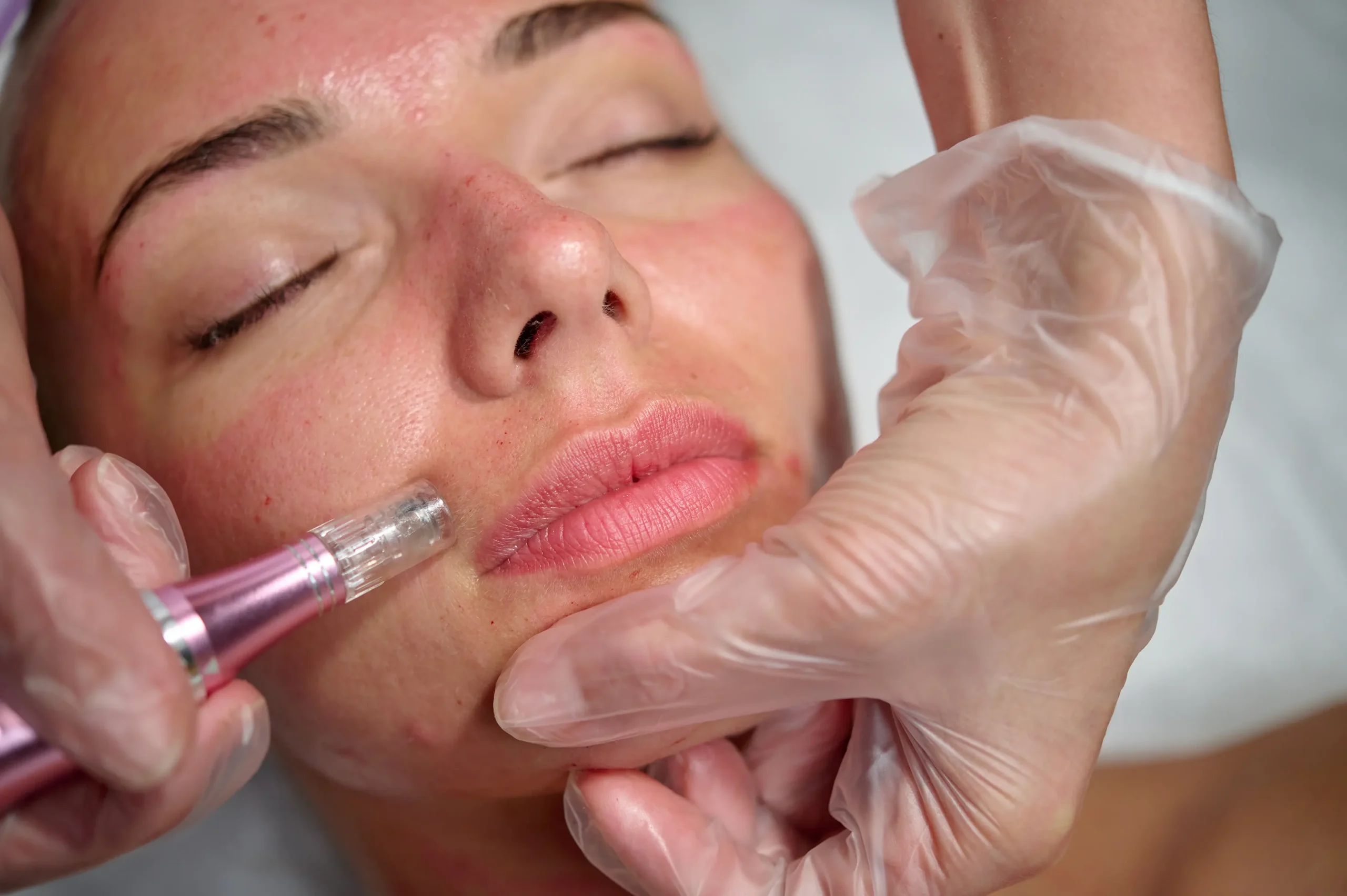 Microneedling - DermaPro - Paris