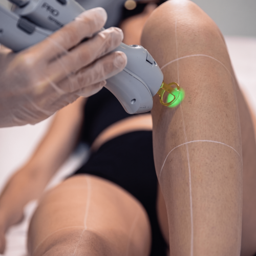 DermaPro-epilation-laser