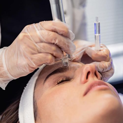 Microneedling visage