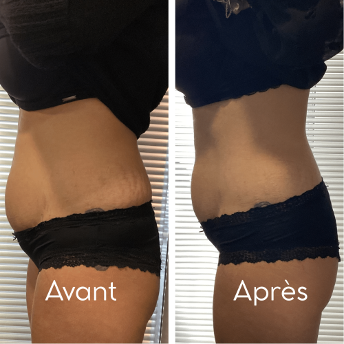 cryo resultados (5)